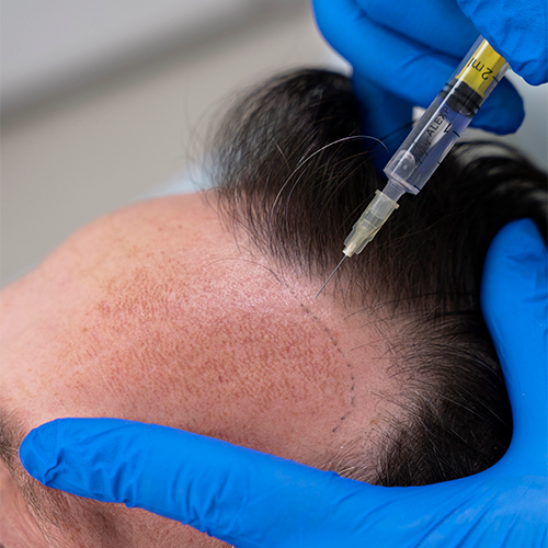 Mesoterapia Capilar