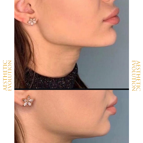 Marcación mandibular